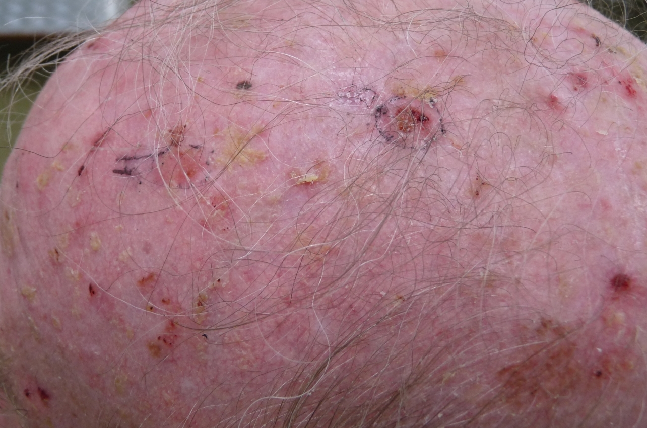 actinische keratosen scalp. Omcirckelkd zijn verdachte laesies voor huidkanker