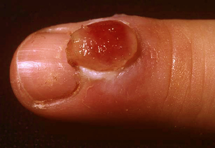 granuloma-pyogenicum