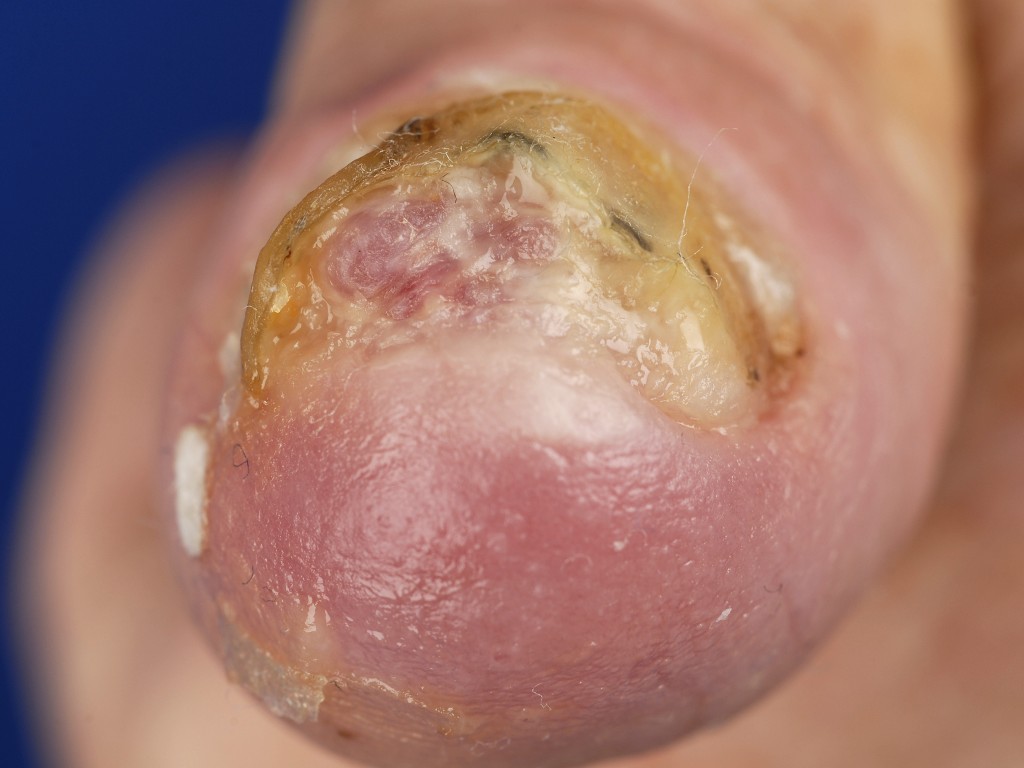 plaveiselcel-carcinoom nagelapparaat