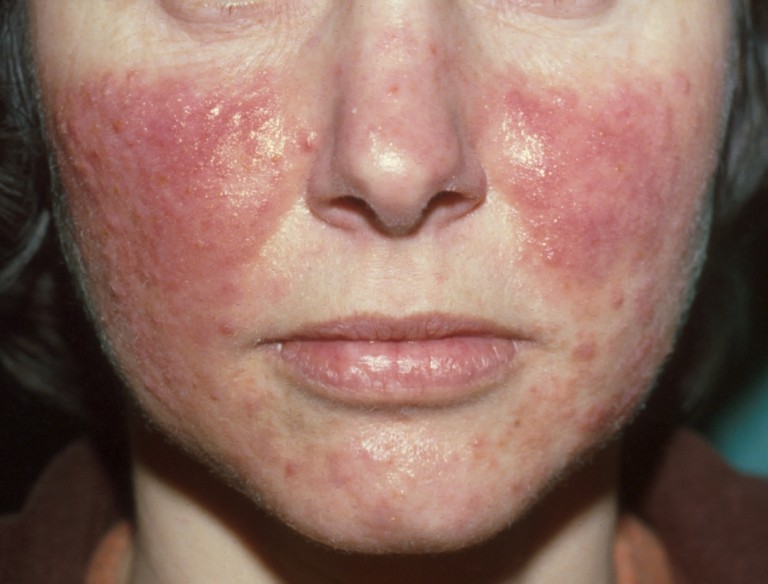 rosacea