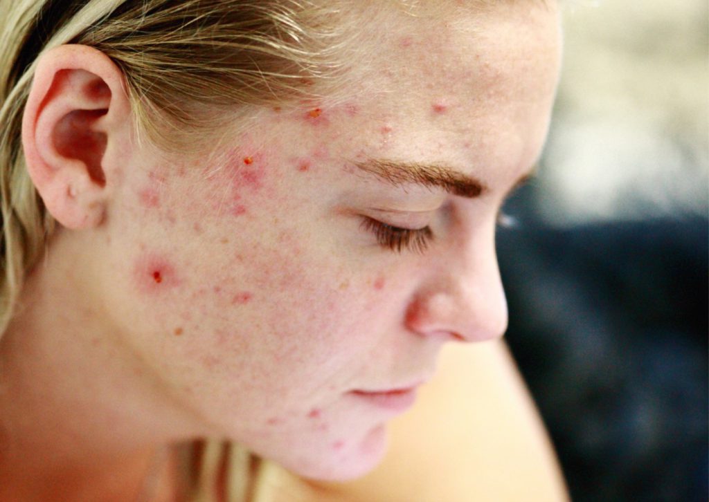 acne huidtherapie