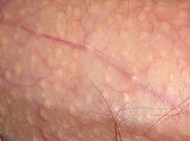 behandeling fordyce spots