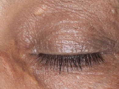 Verwijderen xanthelasma