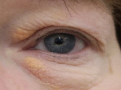 behandeling xanthelasma