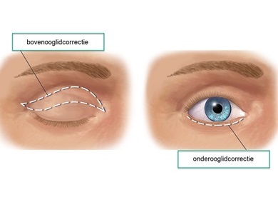 wat is het herstel na ooglidcorrectie