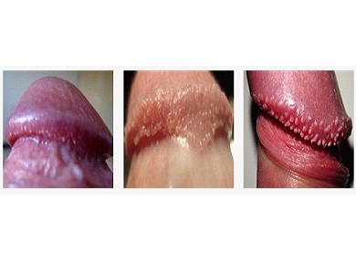 PPP (pearly penile papules)