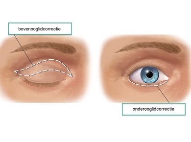 Eyelid correction