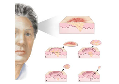 Behandeling basaalcelcarcinoom met Mohs chirurgie