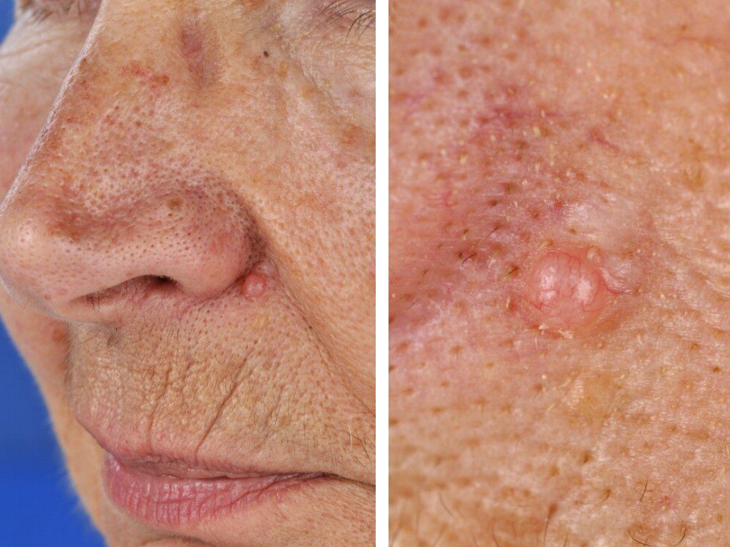 basal cell carcinoma on the face