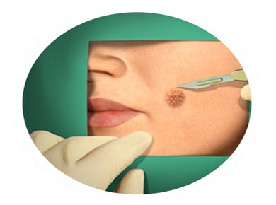 Facial skin cancer treatment